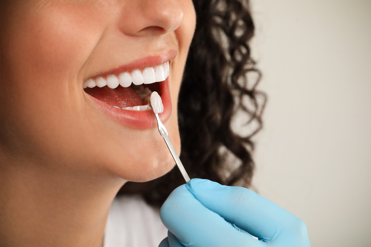 Teeth Whitening: Professional vs. At-Home Kits – What Works Best?