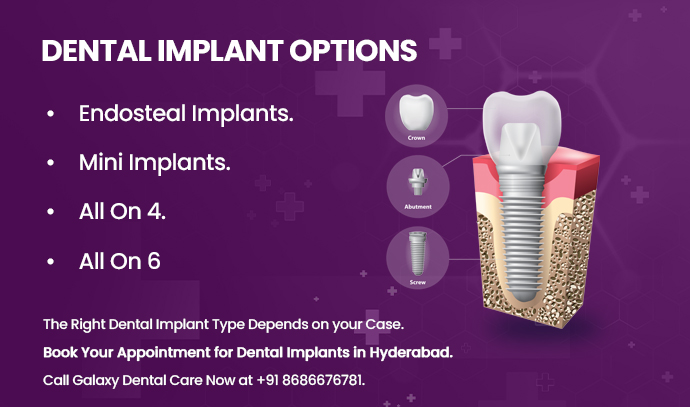 dental implant type