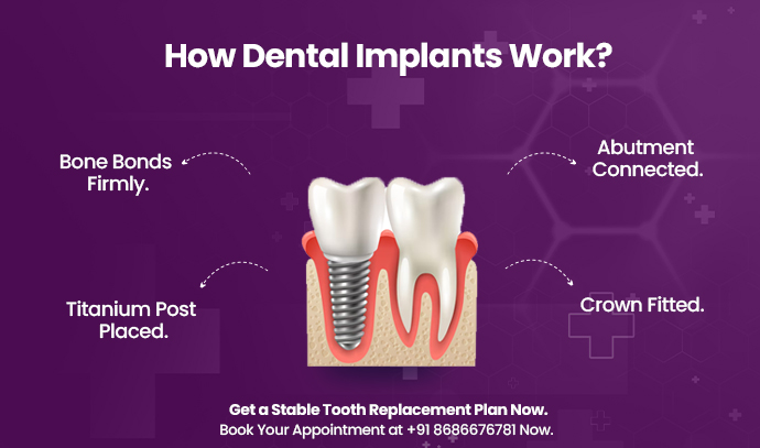 dental implants work inside