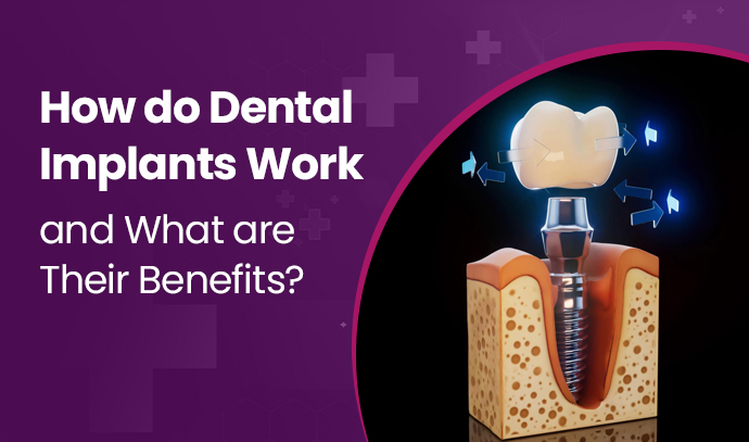 How do Dental Implants Work and What are Their Benefits?