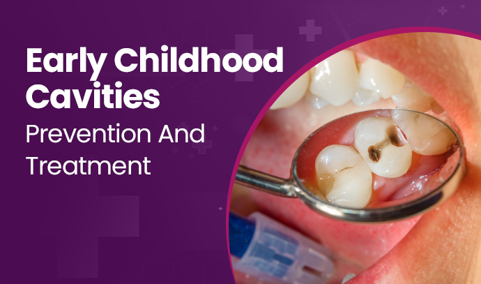 Early Childhood Cavities: Prevention And Treatment