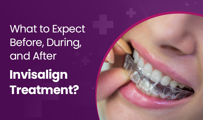 what to expect before during and after invisalign treatment