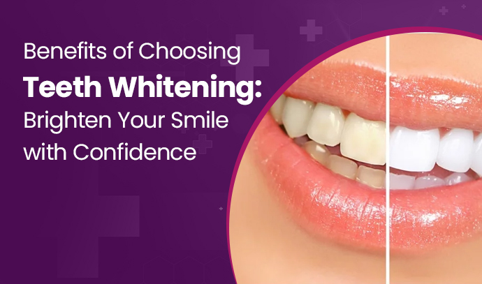 Benefits of Choosing Teeth Whitening: Brighten Your Smile with Confidence