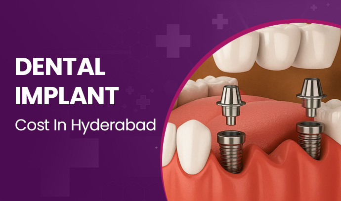 dental implant costs in hyderabad