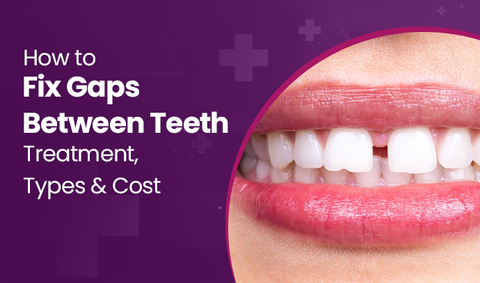 how to fix gaps between teeth