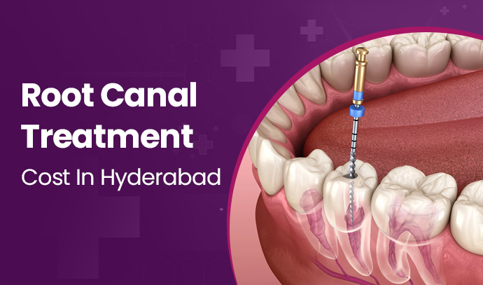 Root Canal Treatment Cost In Hyderabad