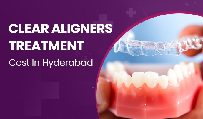 Clear Aligners Treatment Cost in Hyderabad