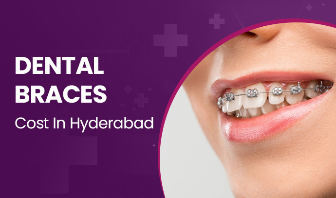 dental braces cost in hyderabad