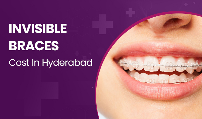 invisible braces cost in hyderabad