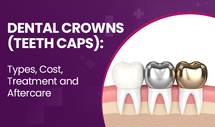 Dental Crowns (Teeth Caps): Types, Cost, Treatment and Aftercare