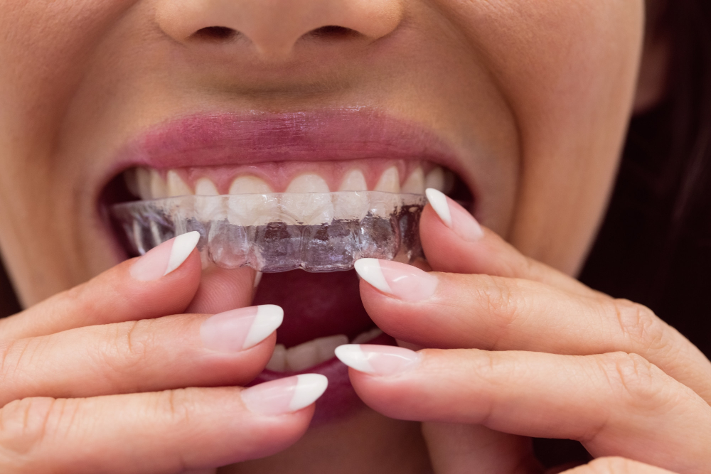 Invisible Aligners
