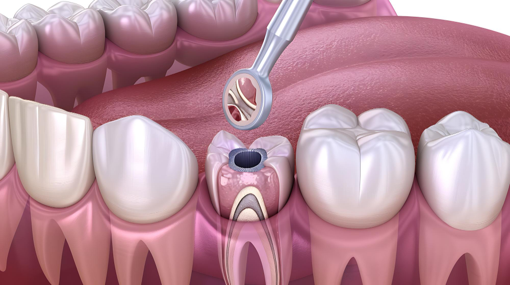 Root Canal Treatment vs Tooth Extraction
