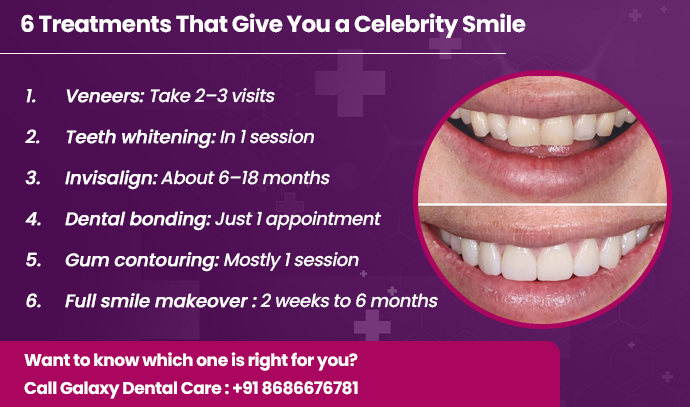 treatments that give you a celebrity smile