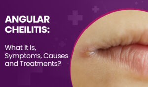 angular cheilitis