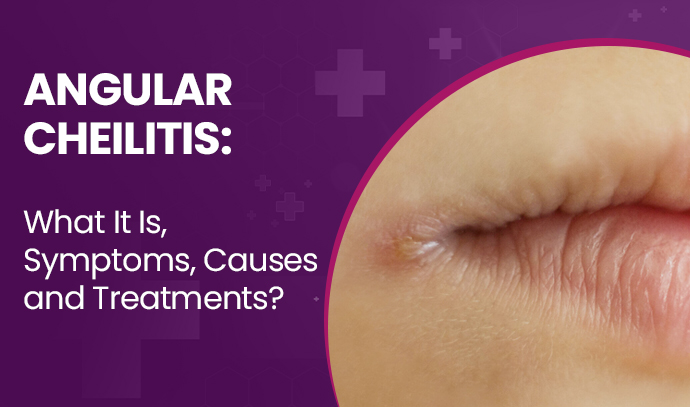 Angular Cheilitis: What It Is, Symptoms, Causes and Treatments?