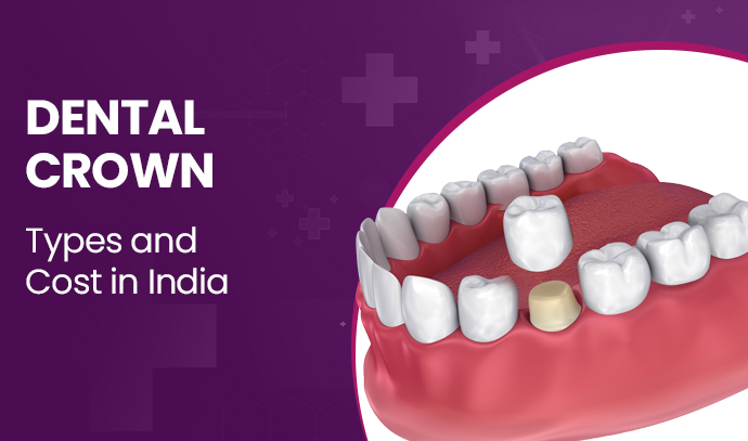 dental crown cost