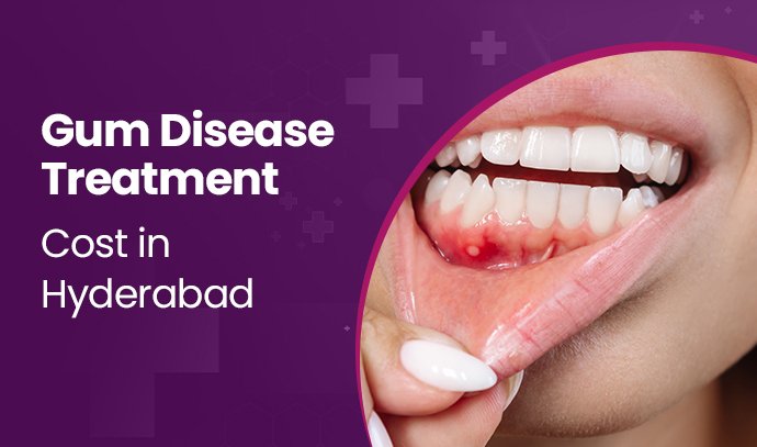Gum Disease Treatment Cost in Hyderabad
