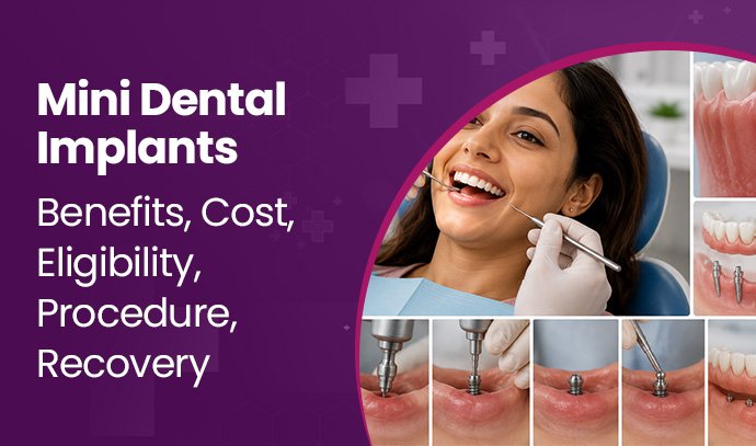 mini dental implants