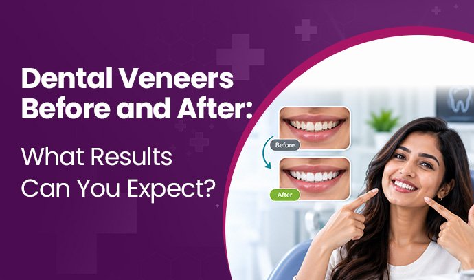 Dental Veneers Before and After: What Results Can You Expect?