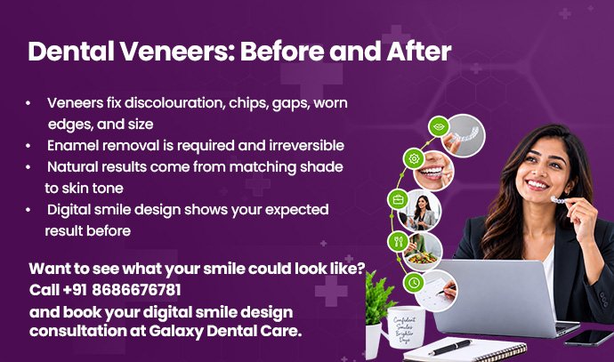 dental veneers before and after